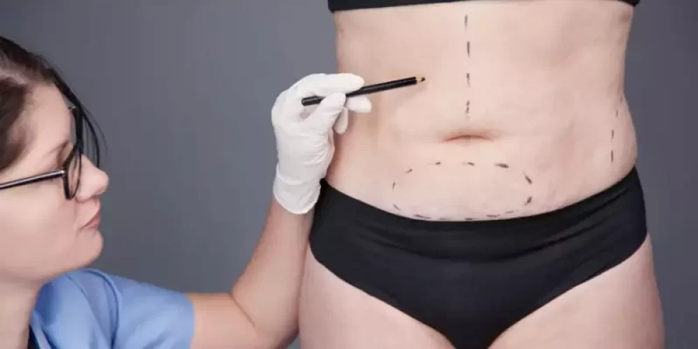 cirurgia-plastica-pos-bariatrica